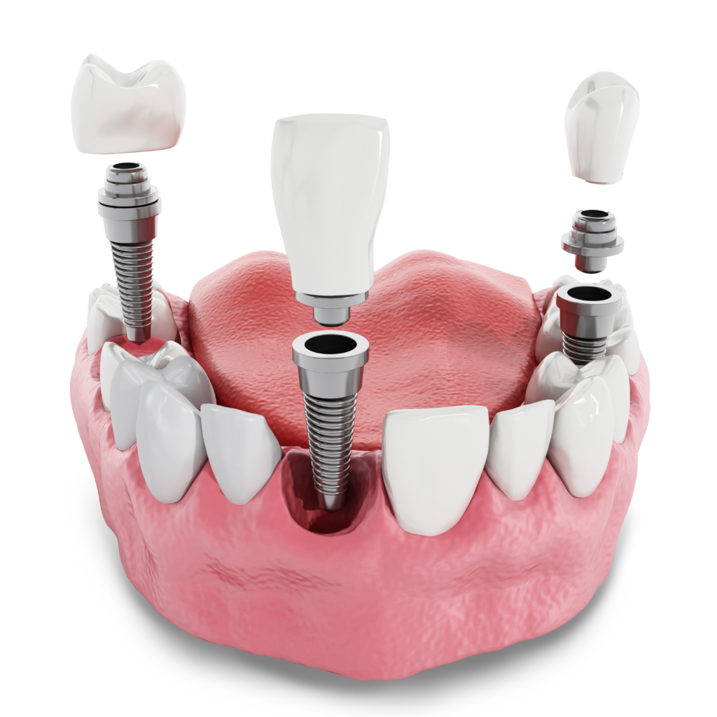dental implant model Leesburg, VA
