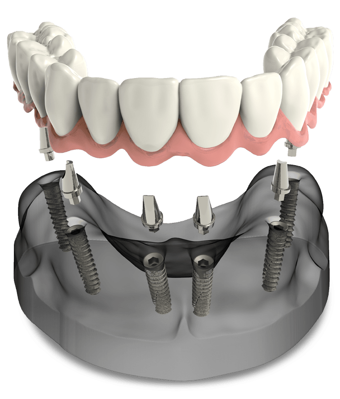 full arch dental implants model Leesburg, VA