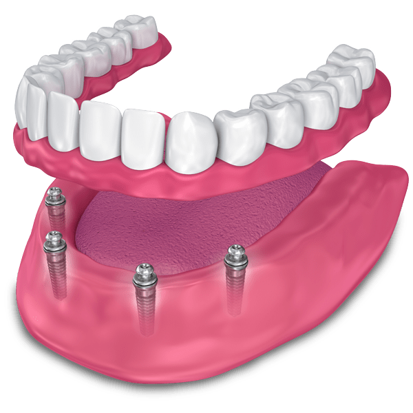 implant supported dentures model Leesburg, VA