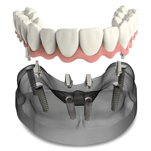a 3d render of a jaw and full mouth dental implants.